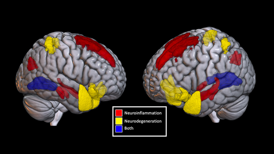 3D rendering of two brains, with red, blue, and yellow segments to highlight neuroinflammation, neurodegeneration, or both.